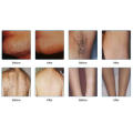 Affordable Diode Laser Hair Removal with Medical Ce, Tga&FDA